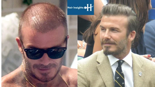 david beckham hair transplant