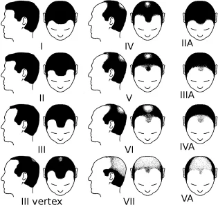 Partial_Norwood_scale_for_male_pattern_baldness.webp Partial_Norwood_scale_for_male_pattern_baldness.webp