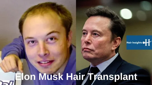 elon musk hair transplant